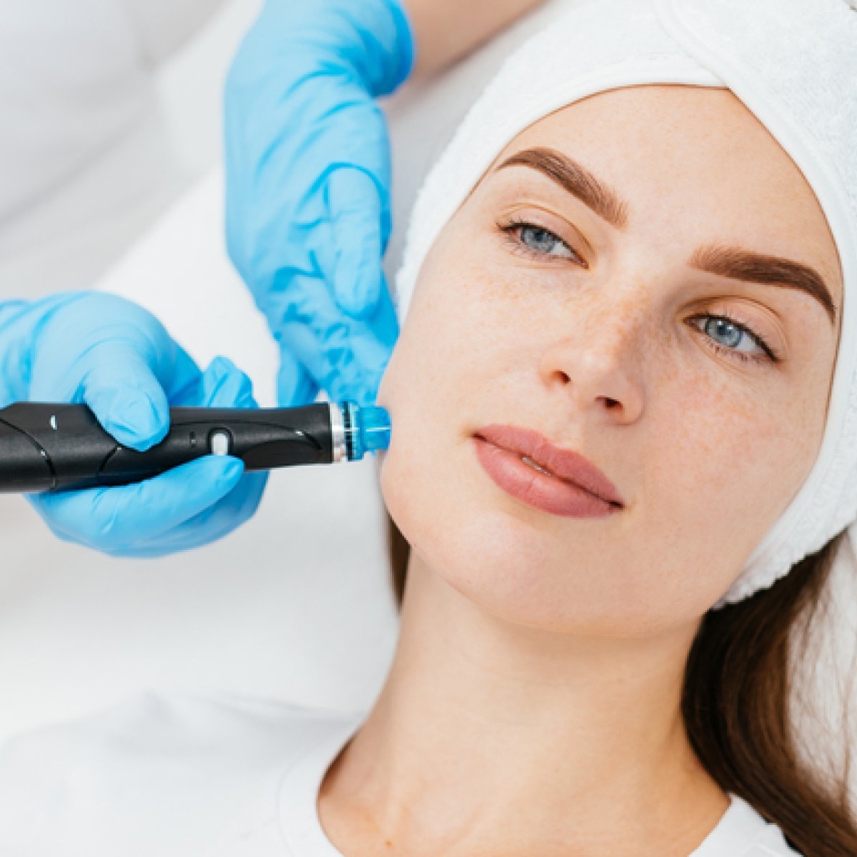 Microneedling cu radiofrecvență: beneficii și recomandări